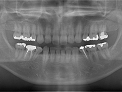 デジタルパノラマレントゲン