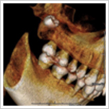 あごに埋まっている歯の診断1
